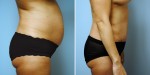 Abdominoplasty