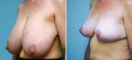 breast-reduction-02b-with-lift-stern