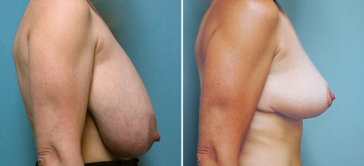 breast-reduction-02c-with-lift-stern
