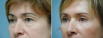 Blepharoplasty (Eyelid lift)
