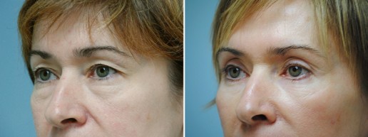 eyelid-lift-01b
