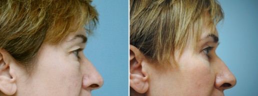 eyelid-lift-01c