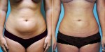 Liposuction