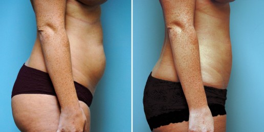 liposuction-01c-stern