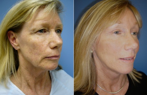 Asheville Facelift