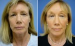 Facelift