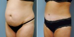 Abdominoplasty