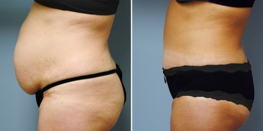 abdominoplasty-02c-stern
