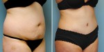 Abdominoplasty