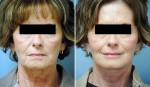 Facelift