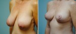 Breast Reduction